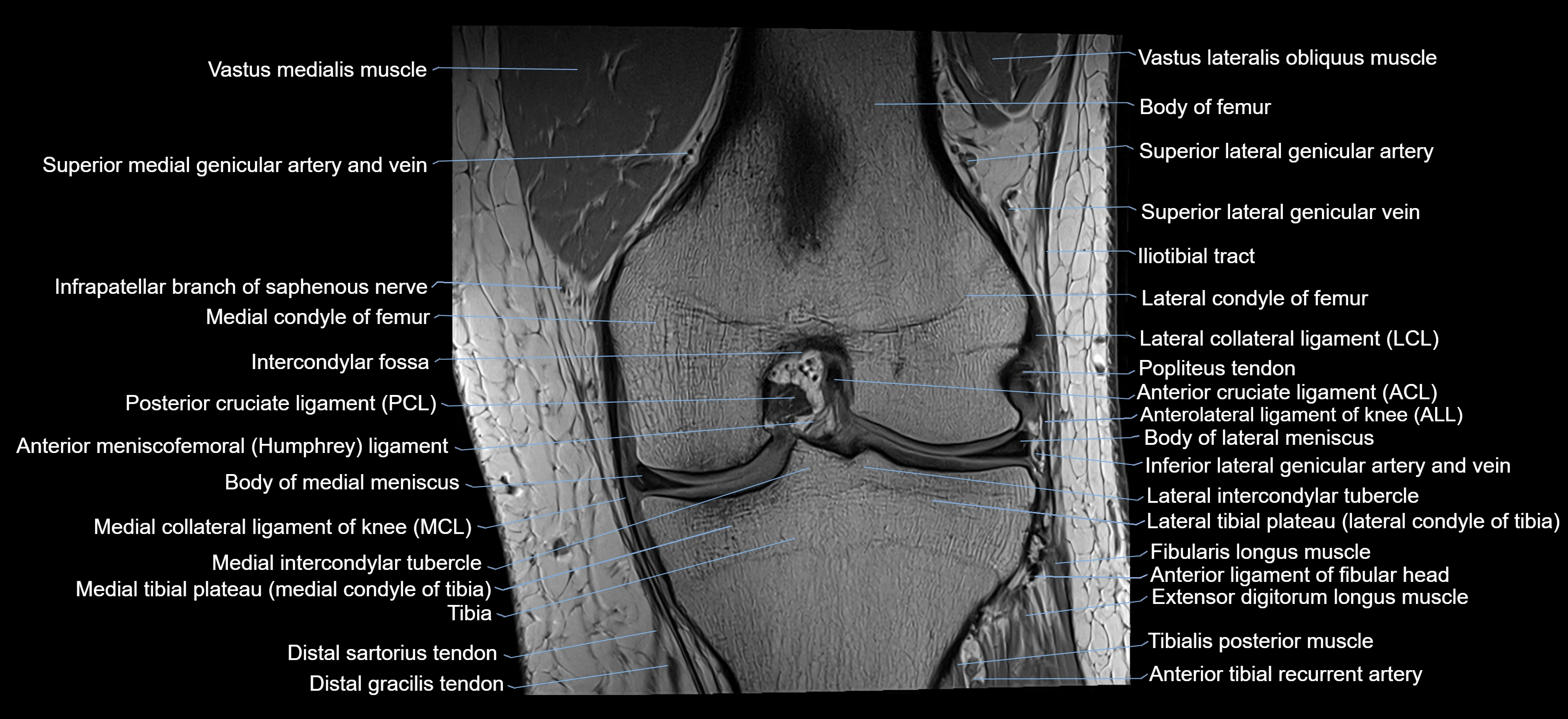 MRI knee coronal cross sectional anatomy labelled 3T radiology  image-04001-00022.webp